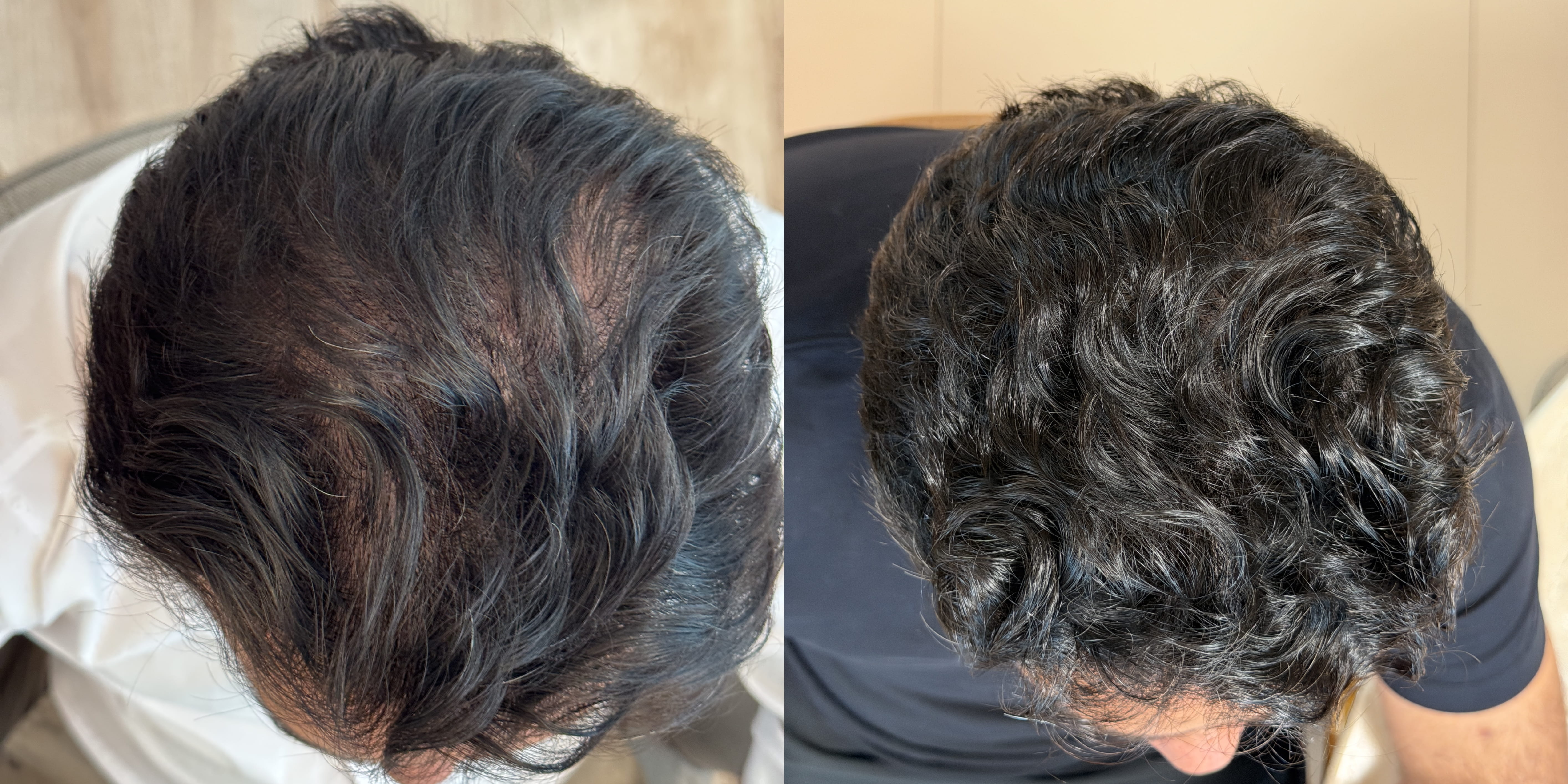 Comparativo do topo do couro cabeludo de um paciente do sexo masculino, antes e durante o acompanhamento.